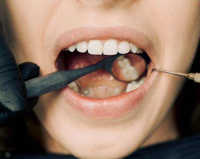 Do You Have Gum Disease? Look Out For These 5 Common Signs!